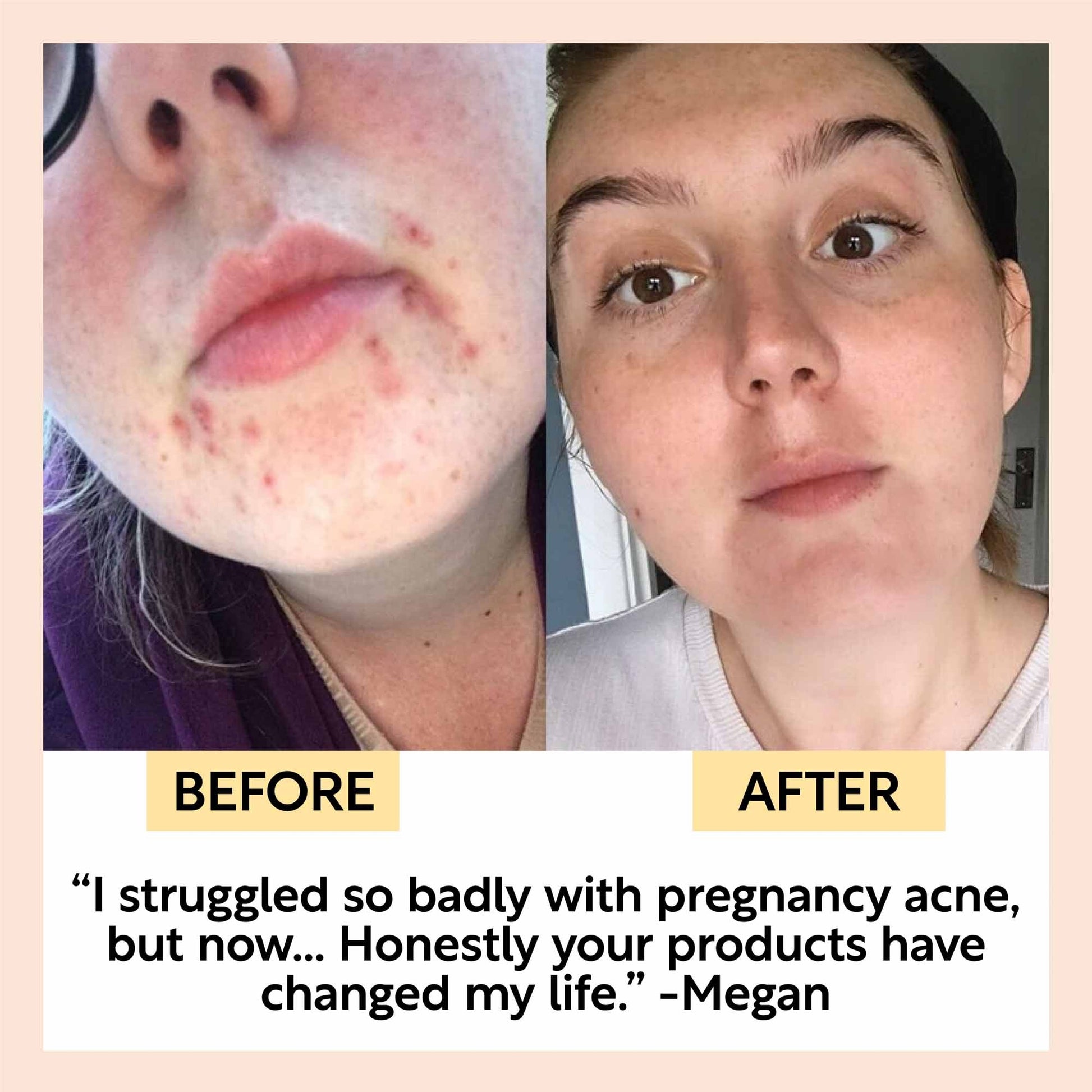 before and after photograph of woman who used the upcircle products showing acne around the mouth that had disappeared