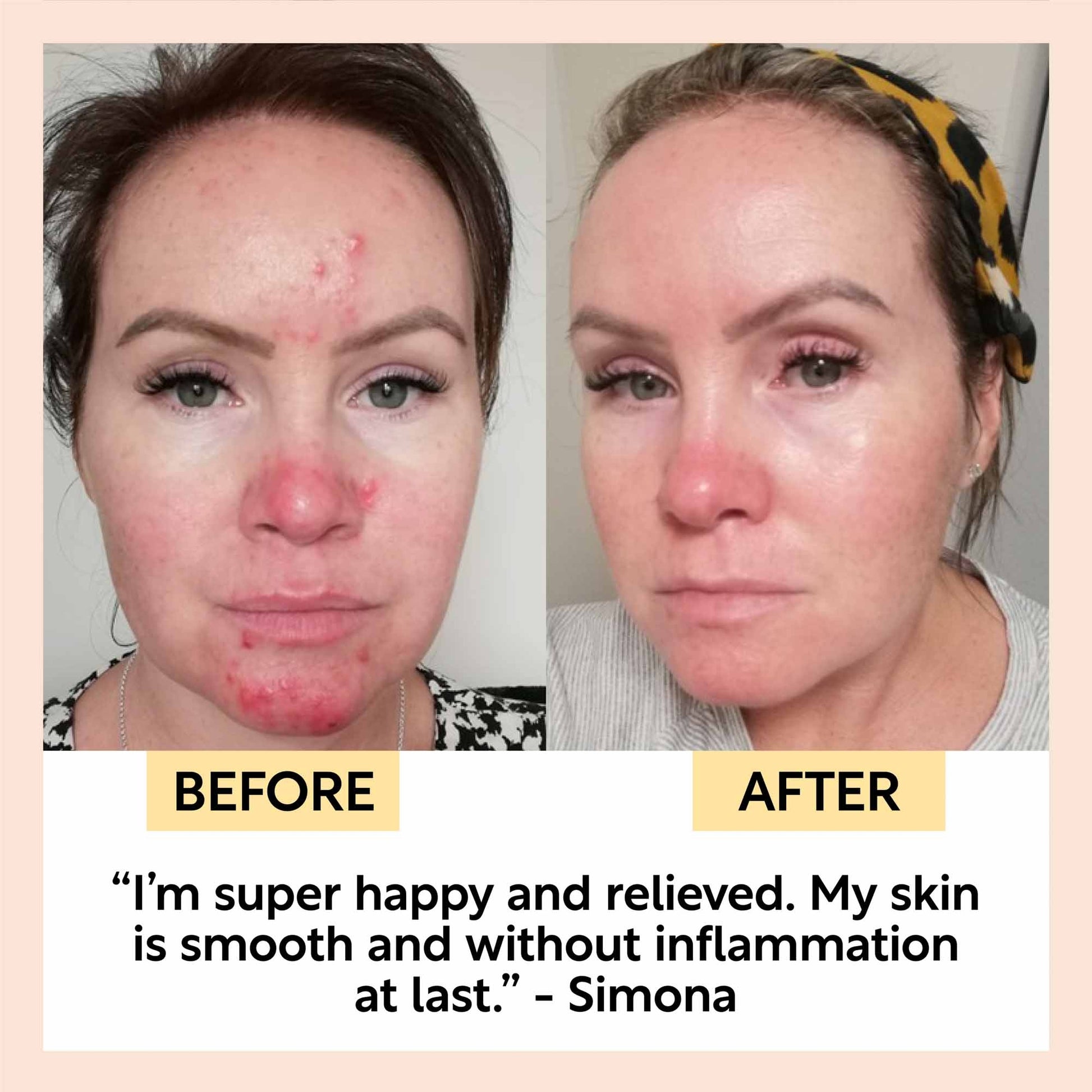 before and after photograph of woman who used the upcircle night cream. before she had large pustules of acne on her forehead, nose and chin and afterwards her skin looks clear and hydrated